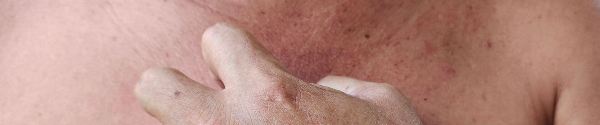 Mujer mayor que sufre de dermatitis atópica en el pecho. Se está rascando para calmar su escozor, pero esto solo está complicando más su problema con la dermatitis atópica.