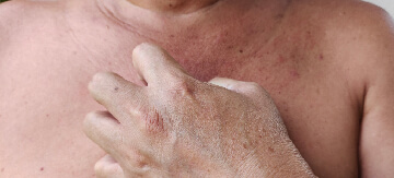 Mujer mayor que sufre de dermatitis atópica en el pecho. Se está rascando para calmar su escozor, pero esto solo está complicando más su problema con la dermatitis atópica.